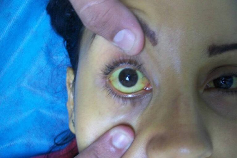 Management of Obstructive Jaundice Dr. Narendra Chopde