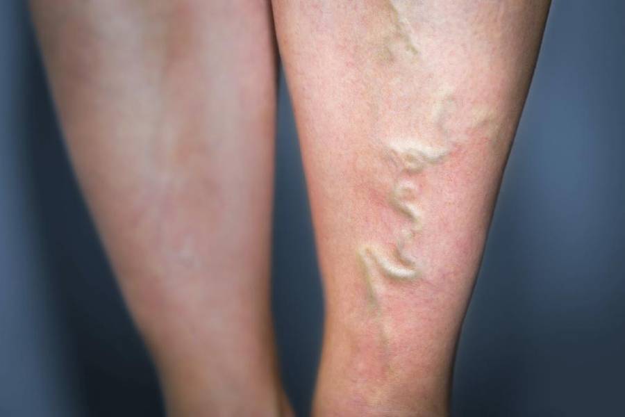 Laser Treatment for Varicose Veins
